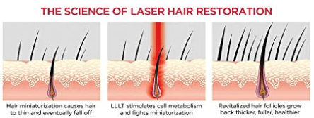 The science of laser hair restoration